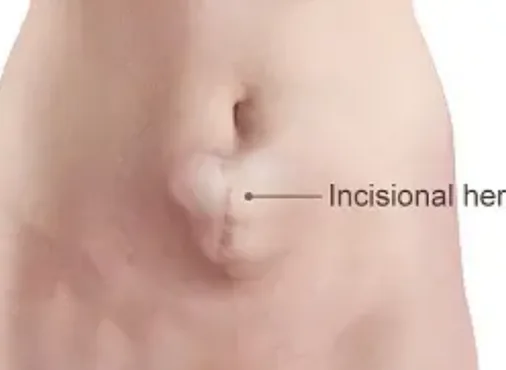 Incisional Hernia consultation at Niraaya Hospital
